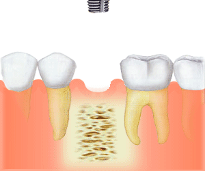 Implant - Implantes Dentários