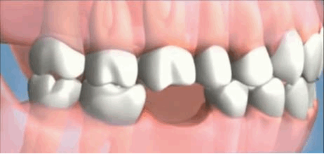 giphy - Implantes Dentários