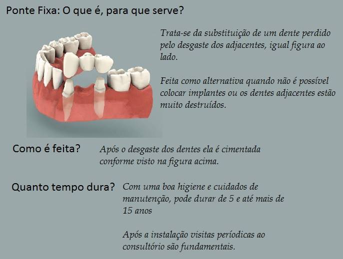 ponte fxa - Reabilitação Oral