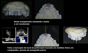 técnica implante repor dentes ausentes