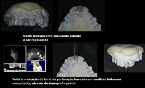 12710950 1158201860866136 245855838331026107 o 300x182 - Implantes Dentários