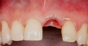 implante repor dentes ausentes