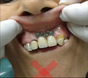 erro implante repor dentes ausentes