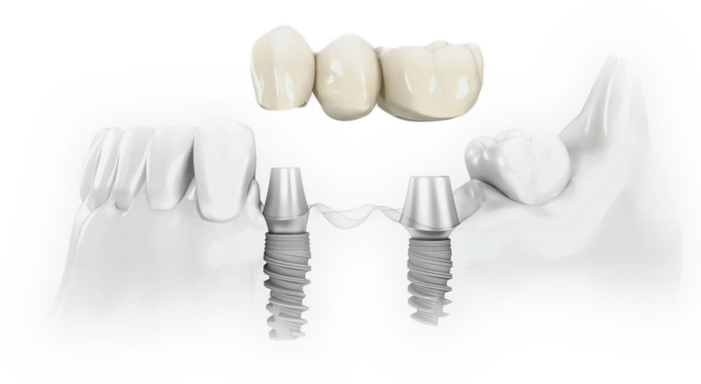 implante2 1024x561 - Reabilitação Oral