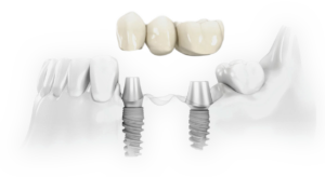 dois implantes repor dentes ausentes