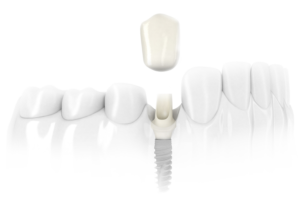 um implante repor dentes ausentes