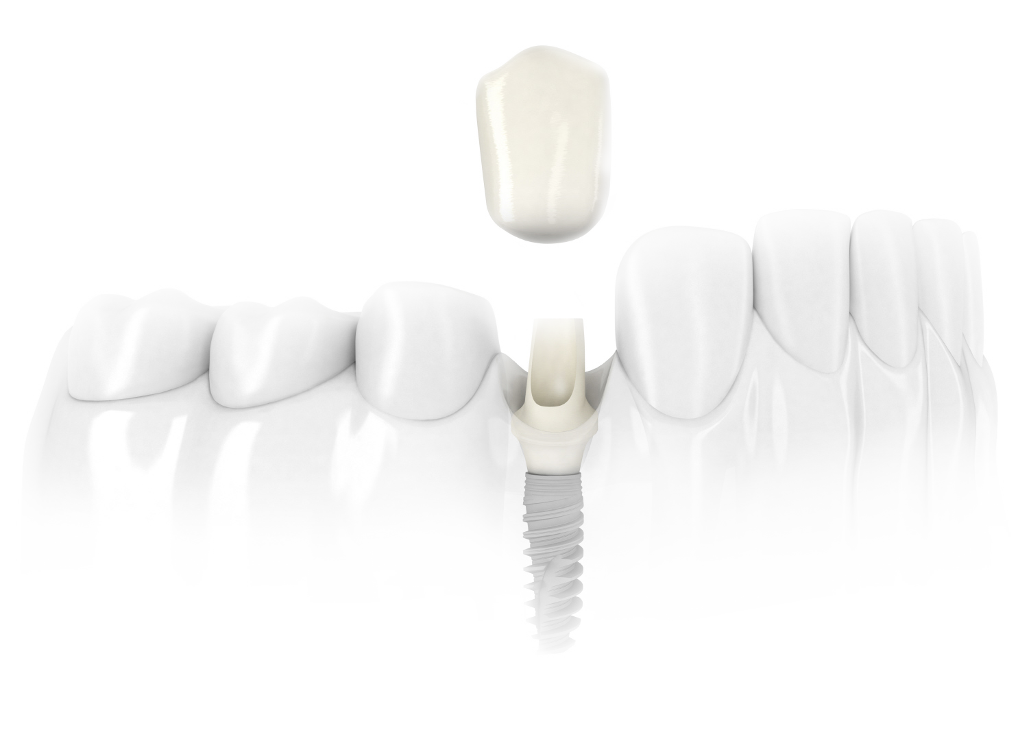 implante3 - Implantes Dentários