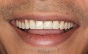 smile makeover 300x185 - Implantes Dentários