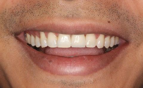 smile makeover - Implantes Dentários