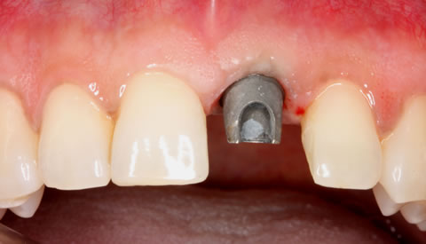 titanium abutment - Implantes Dentários