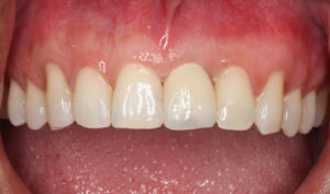 tooth implant crown 300x177 - Implantes Dentários