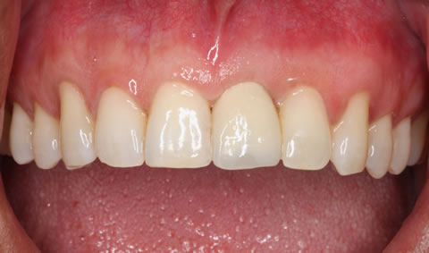 tooth implant crown - Implantes Dentários