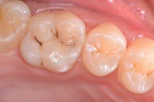 Cárie Oculta 2 e1494810532848 300x200 - Dentes sensíveis