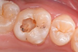 Cárie Oculta 3 e1494810498434 300x200 - Dentes sensíveis