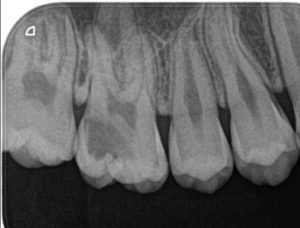 Cárie oculta 300x228 - Dentes sensíveis