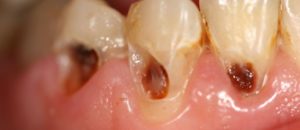 LifeCare Dental Dental Caries 924x400 1 300x130 - Dentes sensíveis