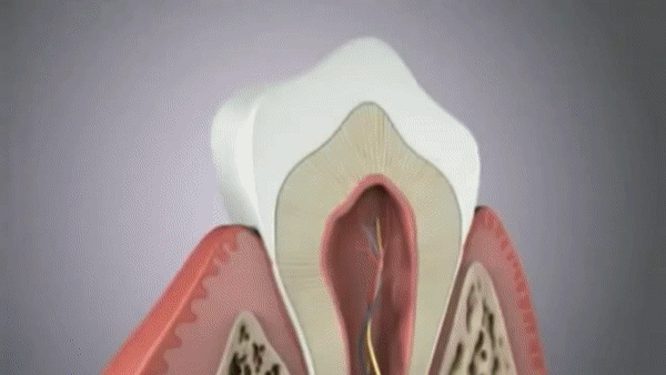 Sensibilidade - Dentes sensíveis