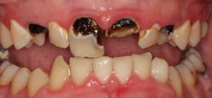 cárie rampante 300x140 - Dentes e Antibióticos