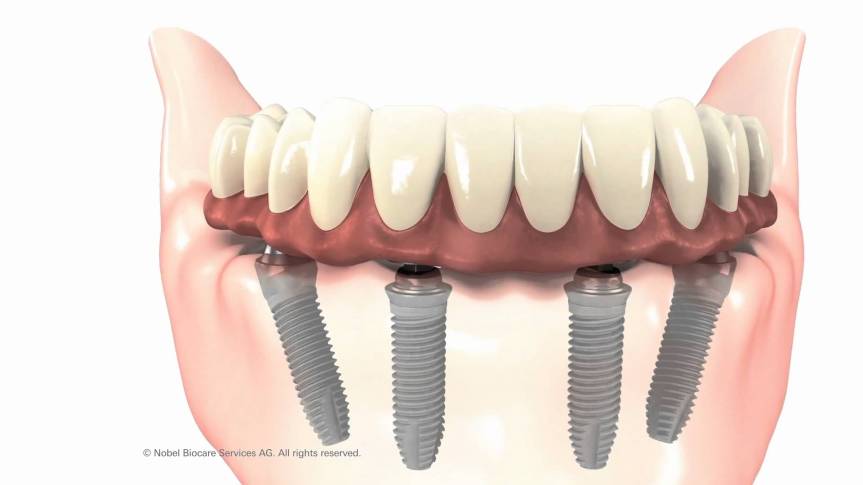 maxresdefault - Implantes Dentários