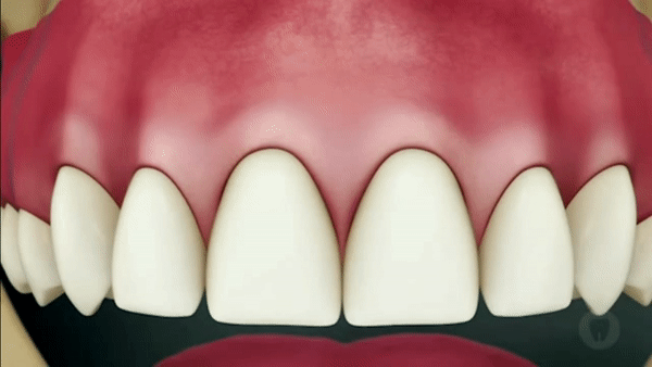 rescessão - Dentes sensíveis