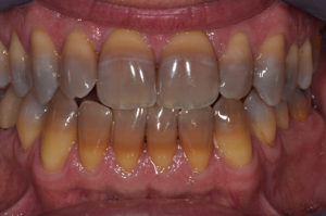 tetraciclina 300x199 - Dentes e Antibióticos