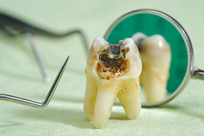 cárie dentária - Tratamento de canal