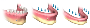 full jaw bone loss 300x93 - Dentadura Convencional