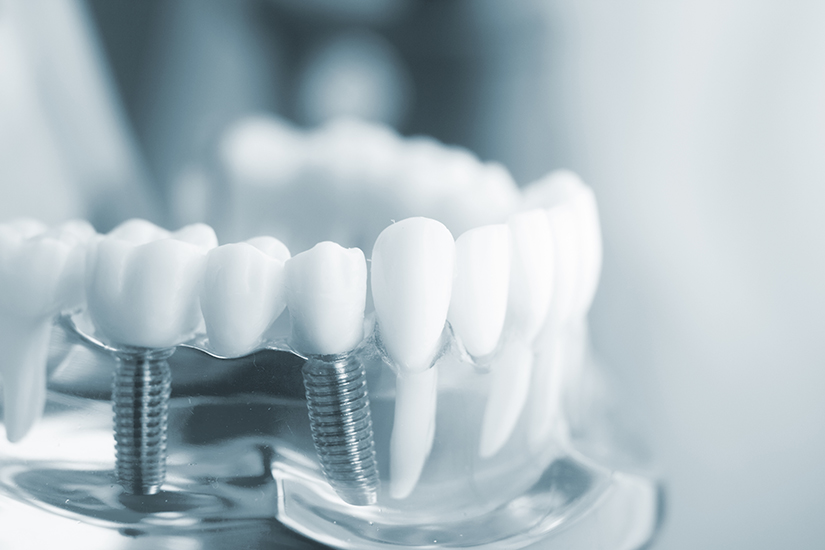 how much are dental implants 1 - Implantes Dentários