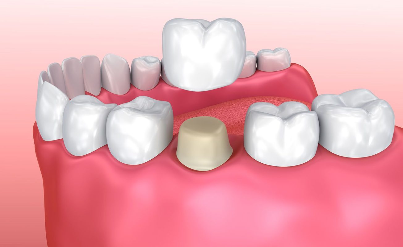 porcelana 1 - Reabilitação Oral
