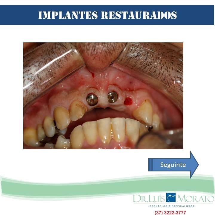 implante1 - Reabilitação Oral
