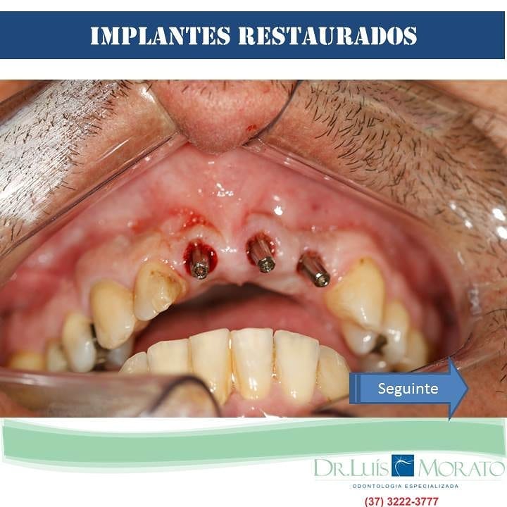 implante2 - Implantes Dentários