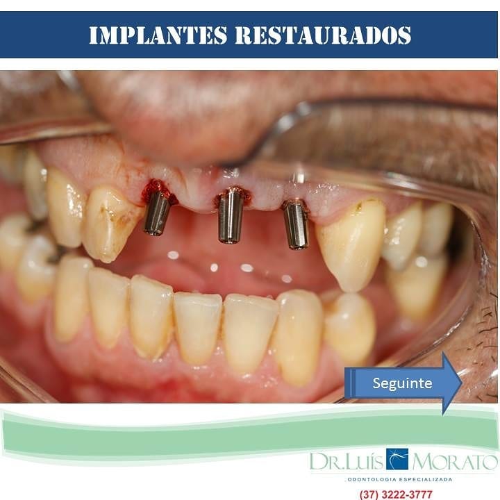 implante3 - Reabilitação Oral