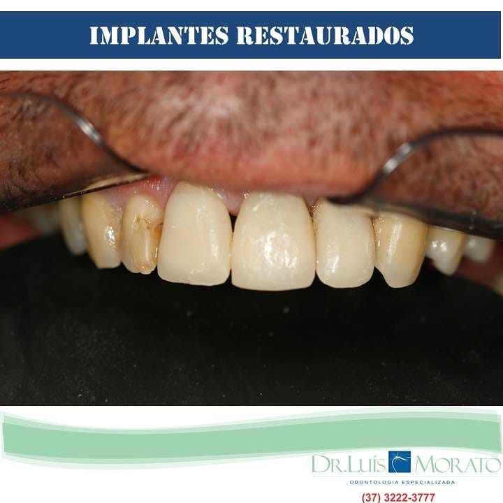 implante4 - Implantes Dentários