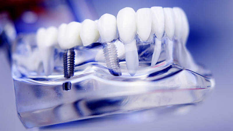 dental implant model - Implantes Dentários