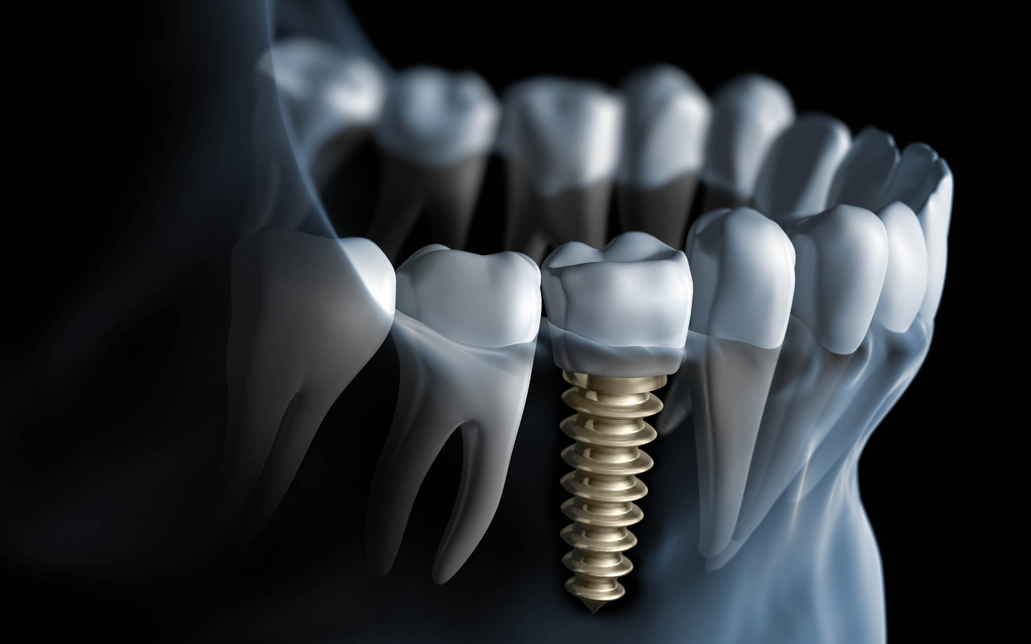 dental implants - Implantes Dentários
