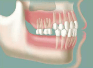 dente faltando - Reabilitação Oral