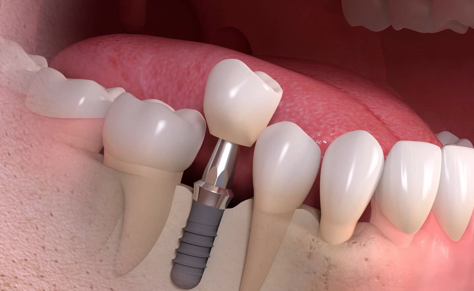 implantes dentários - Reabilitação Oral