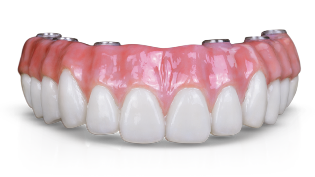 kisspng dental implant dentures dentistry prosthesis fixed sbiancamento denti in croazia i migliori dentist 5b84522b05caa1.7020749815353984430237 - Quem sou eu
