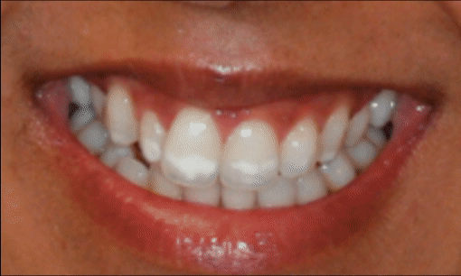 sorriso gengival - Reabilitação Oral