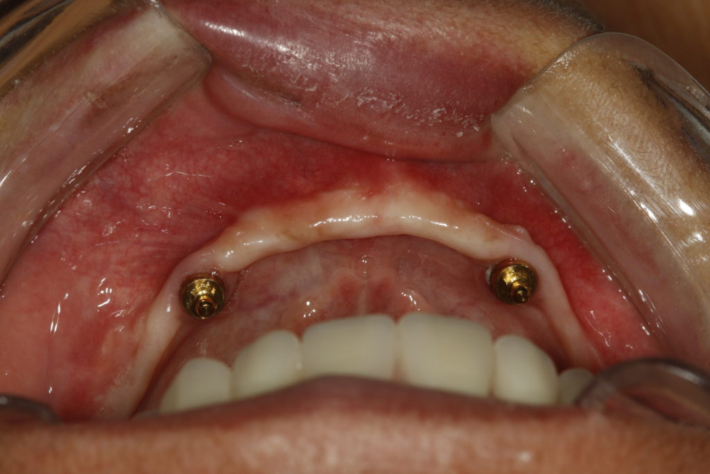 MG 5472 1024x683 - Overdenture