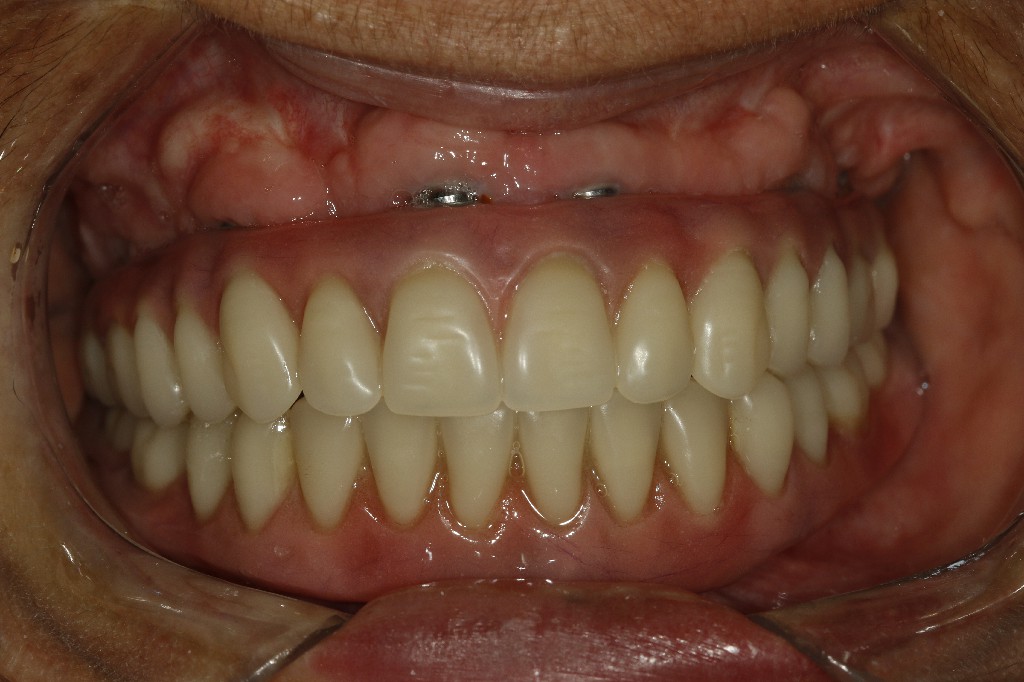 MG 5492 - Overdenture