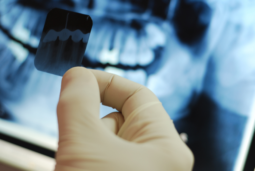 curso de radiologia dental - Tratamento de canal