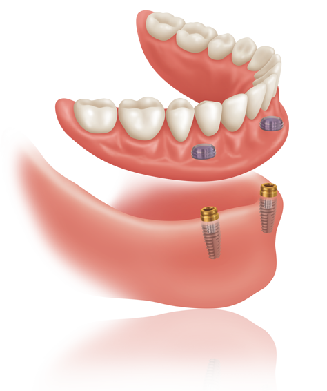 kisspng dental implant dentures dentistry en stabilisation d39un appareil amovible chir 5bad28e2345114.4775876315380748502143 - Overdenture