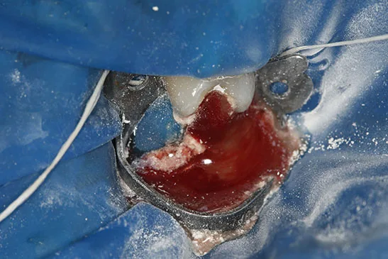 Abscesso dentário sendo drenado — consequência de canal não tratado