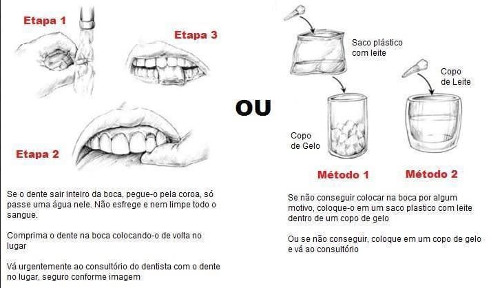 Passo a passo avulsão dentária