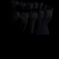 ezgif.com resize 3 - Implantes Dentários