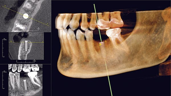 Tomografia 3D com planejamento de implante dentário — Dr. Luís Morato Divinópolis