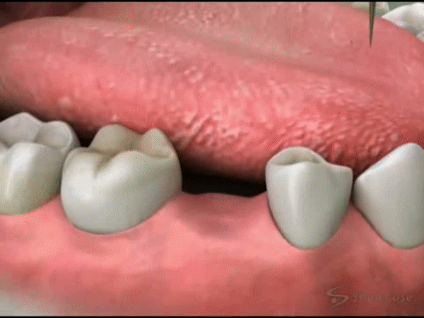 ezgif.com video to gif - Implantes Dentários