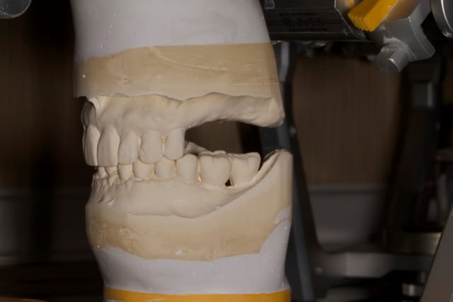 Modelo de gesso montado em articulador — planejamento para implante