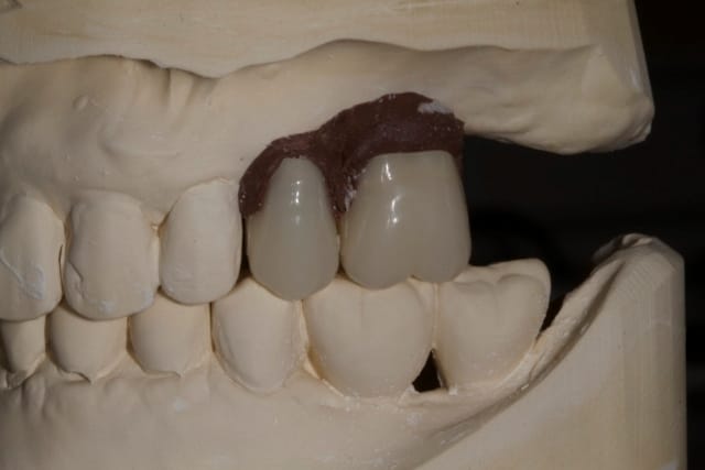 Dente posicionado no modelo de gesso — simulação do resultado